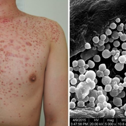 Narbige Entzündung der Haarfollikel auf Männlicher Brust