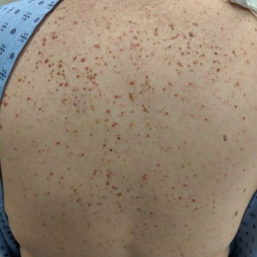 Kutane Mastozytose am Rücken.