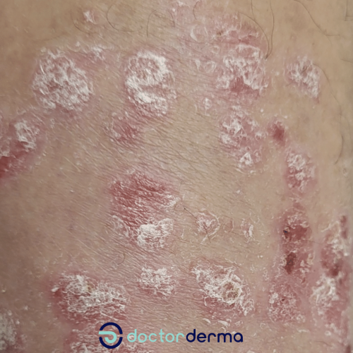 Psoriasis