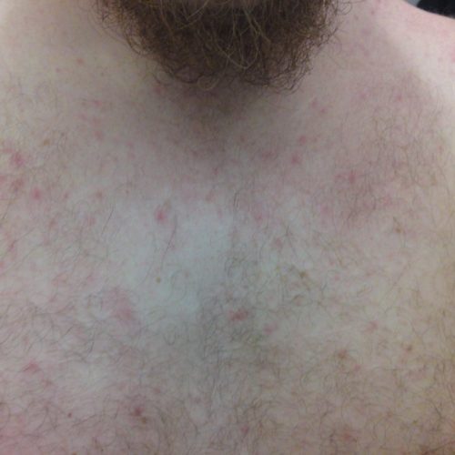 Hitzepickel auf Männlicher Brust