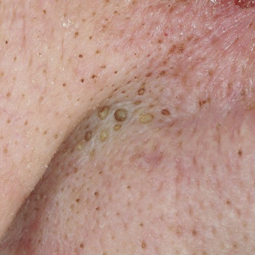 Mitesser (Black Heads) in der Nasolabialfalte