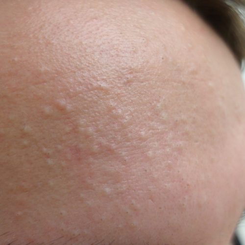 Mitesser auf der Stirn