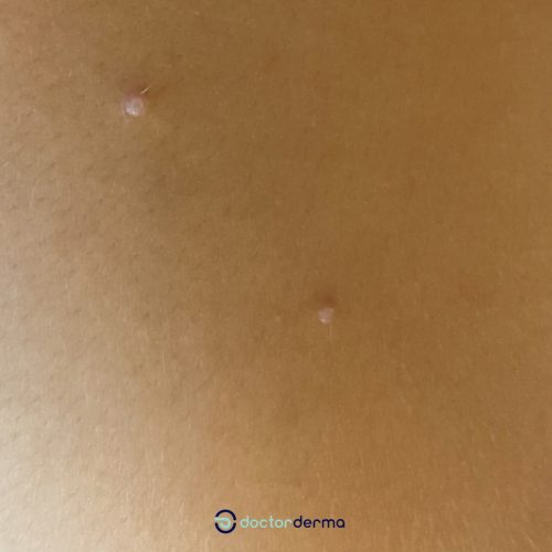 Molluscum contagiosum
