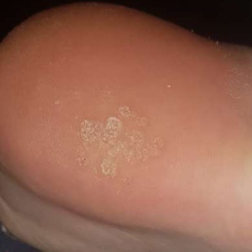 Mosaikwarzen an der Fußsohle