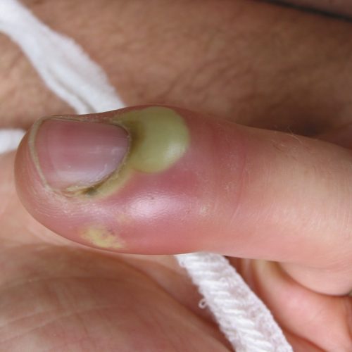 Nagelbettentzündung