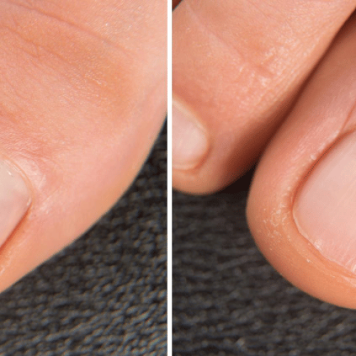 Gesunder Nagel vs. Pilzbefall