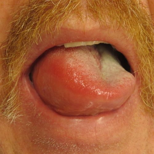 Stark geschwollene Zunge