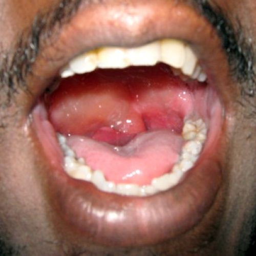 Stark geschwollener Rachenraum