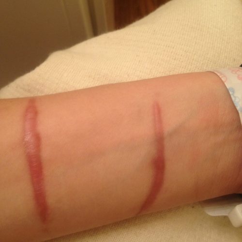 Hypertrophe Narbe nach einem Unfall