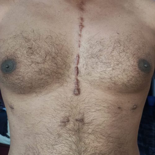 Narbe nach Operation am Sternum