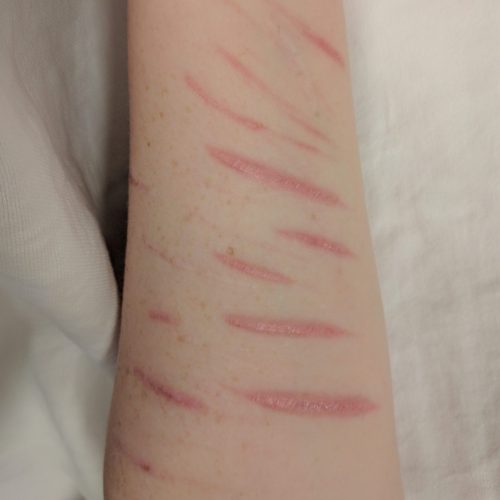 Narben nach Selbstverletzung am Unterarm