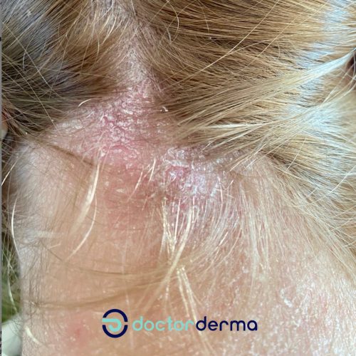 Hinterkopf einer Frau mit Neurodermitis am Haaransatz