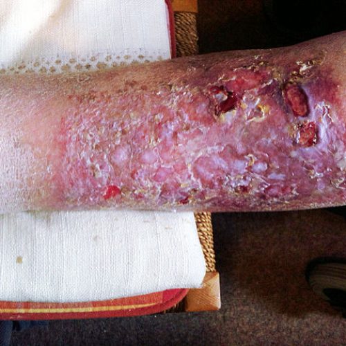 Großflächige narbige Hautveränderung mit Ulzerationen