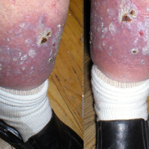 Beidseitig Beinödeme mit Stauungsdermatitis