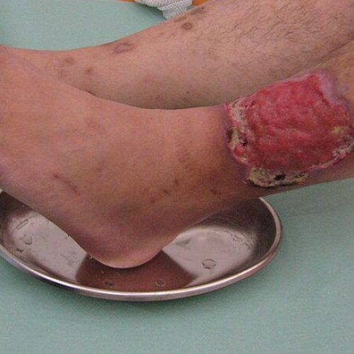 Bein mit offener Wunde (Ulcus cruris) knapp über dem Knöchel