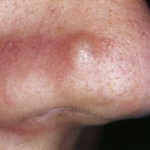 Einzelne Papel auf der Nase einer Patientin