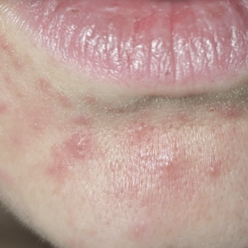 Periorale Dermatitis