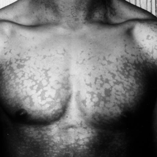 Hautveränderungen durch Malassezia Infektion auf Brust.