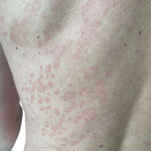 Kleienpilzflechte Rücken