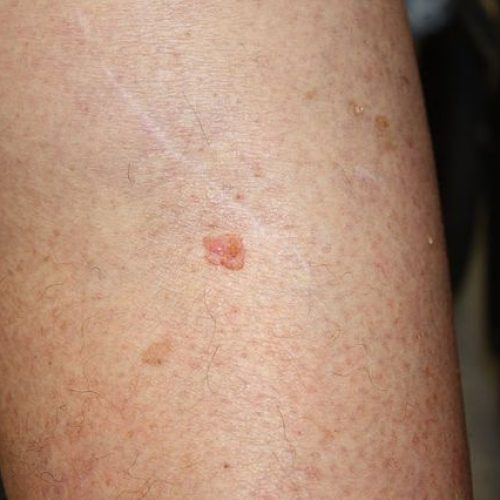 Plattenepithelkarzinom am Bein