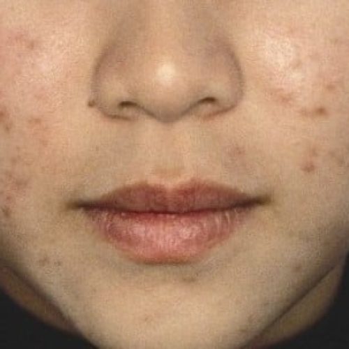 Postinflammatorische Hyperpigmentierung bei Akne