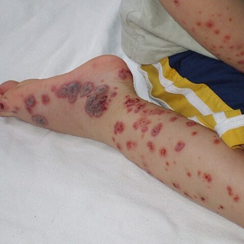 Purpura Schoenlein Henoch Kind
