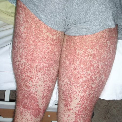 Purpura Schönlein-Henoch Beine