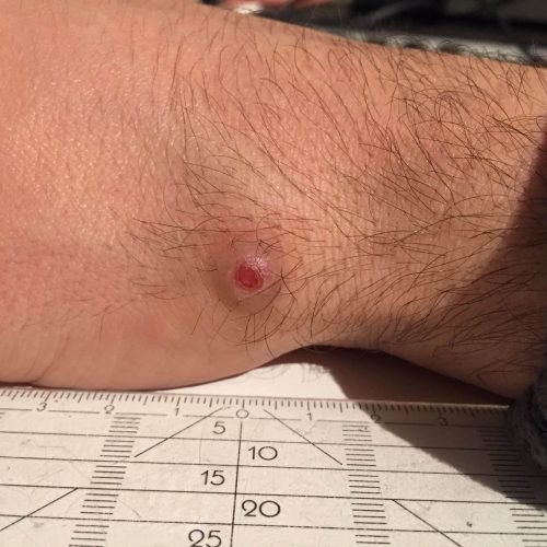 Pyogenes Granulom am Handgelenk