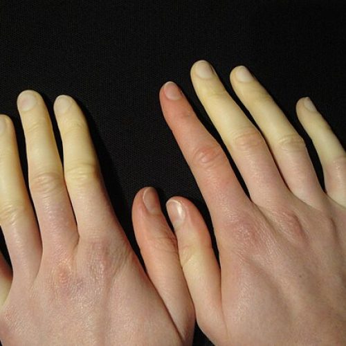 Hand mit blassen Fingern bei Raynaud-Syndrom.