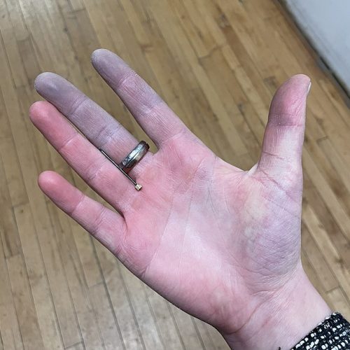 Blaue Finger (Zynose) bei Raynaud Syndrom