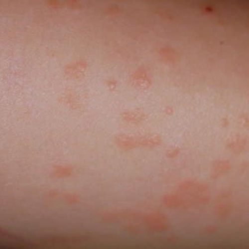 Rötliche und hautfarbene Knötchen auf der Haut.