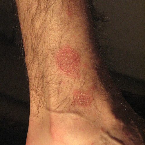 Röschenflechte Arm