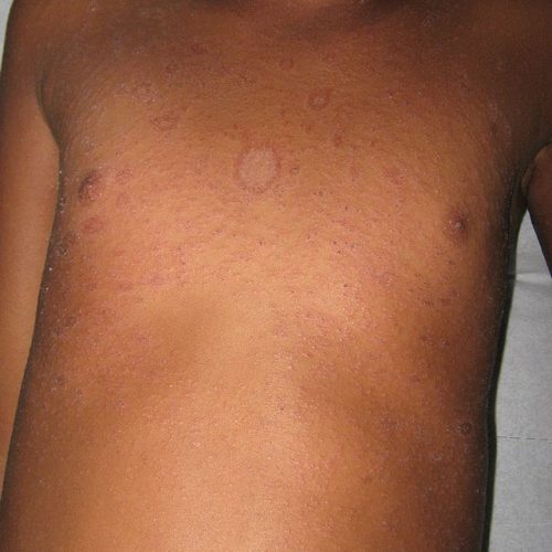 Röschenflechte, dunkler Hauttyp