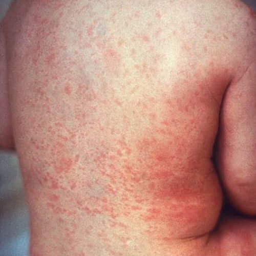 Rubella Ausschlag am Rücken
