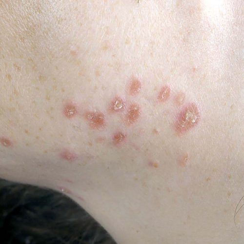 Sarkoidose der Haut in Form von Plaques