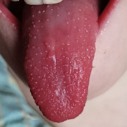 Erdbeerzunge Scharlach