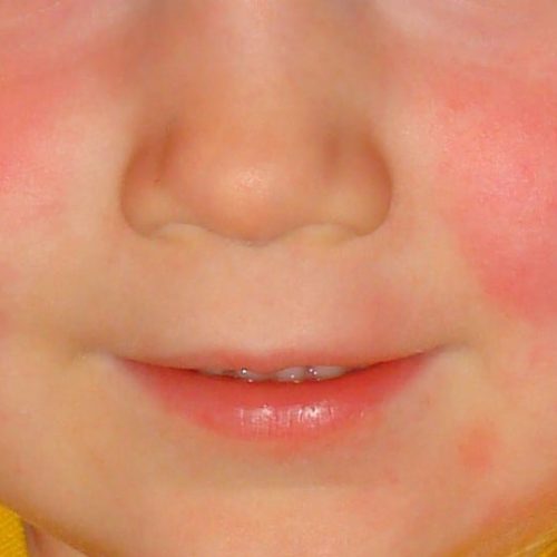 Scharlach Wangen bei Kind