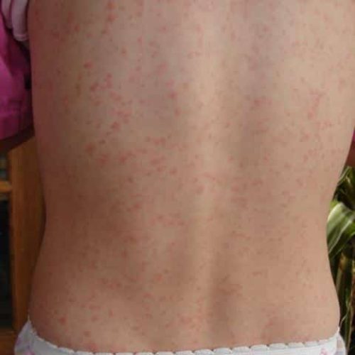 Scharlach-Ausschlag am Rücken