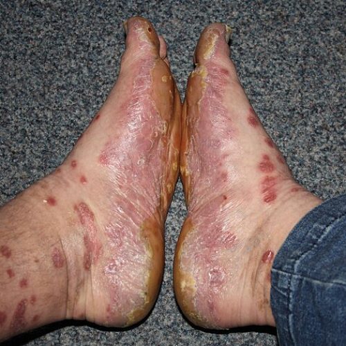 Füße mit charakteristischen Psoriasis Plaques