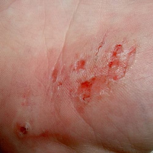 Schürfwunde Handfläche