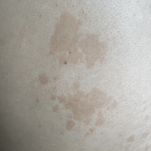 Pityriasis versicolor
