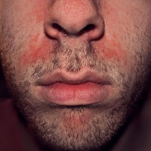 Seborrhoische Dermatitis