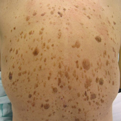 Seborrhoische Keratosen am Rücken