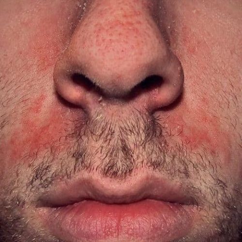 Seborrhoisches Ekzem Gesicht