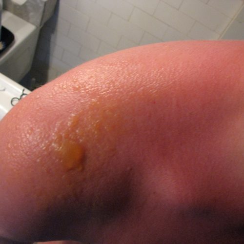 Blasenbildung sind typische Symptome für Sonnenallergie