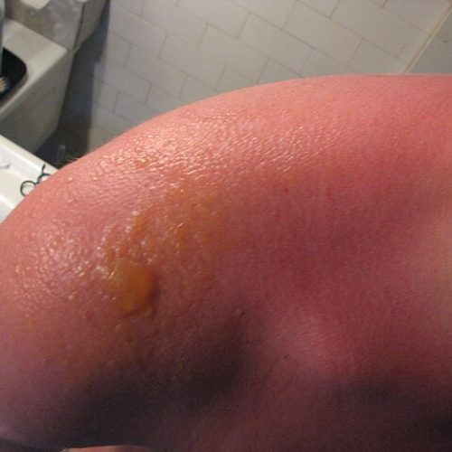 schwerer Sonnenbrand mit Blasenbildung