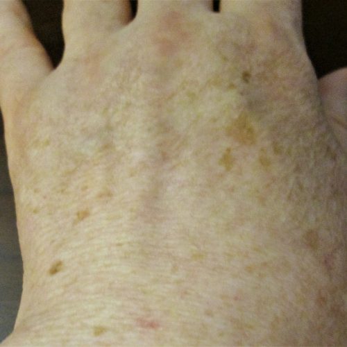 Sonnenflecken an der Hand eines Patienten