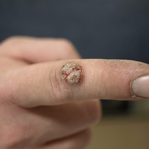 Stachelwarze, Verrucae vulgaris