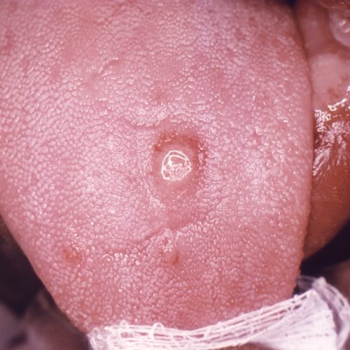 Syphilis Geschwür, Zunge