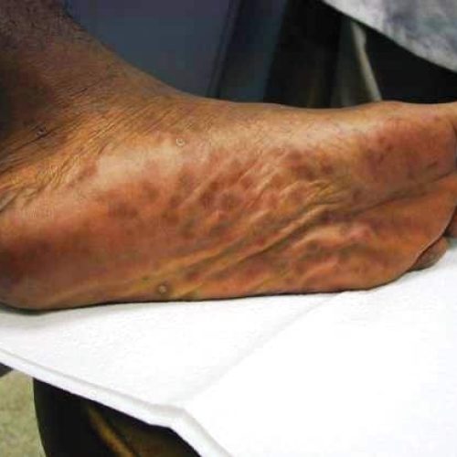 Syphilis, zweites Stadium